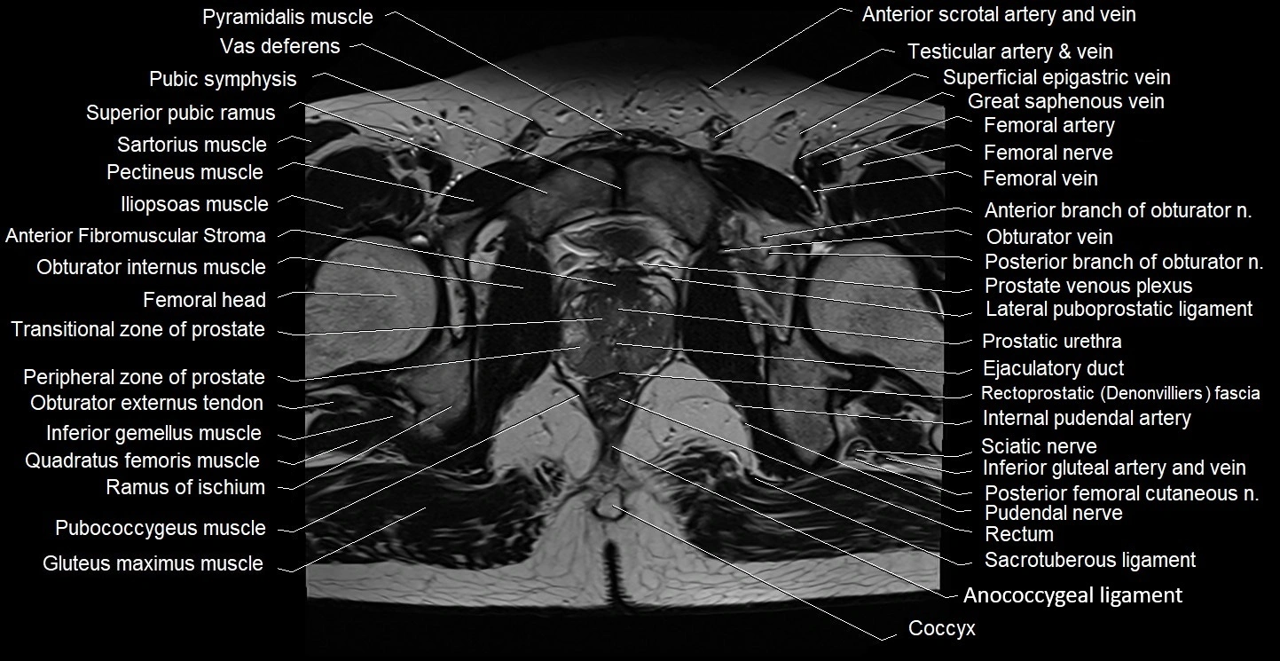 Male pelvis axial cross sectional anatomy image 33.webp